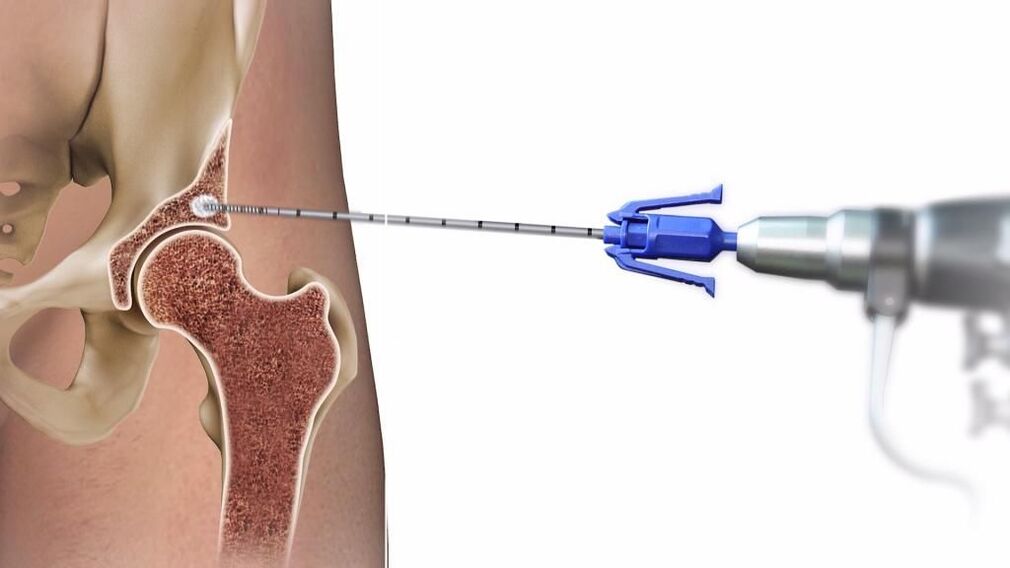 injections into the hip joint
