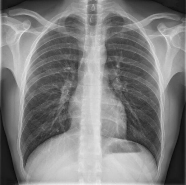 Osteochondrosis of the thoracic spine is diagnosed using radiography
