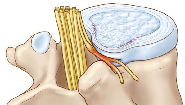 Protrusions of the intervertebral disc that occur with thoracic osteochondrosis compress the nerve endings.
