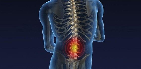 Back pain, with osteocondrosis of the waist