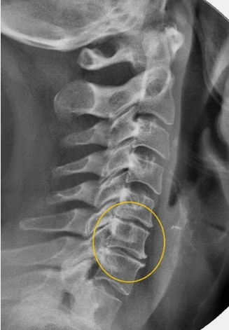 X -Ray osteocondrosis of the cervical waist