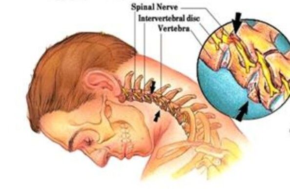Cervical osteocondrosis