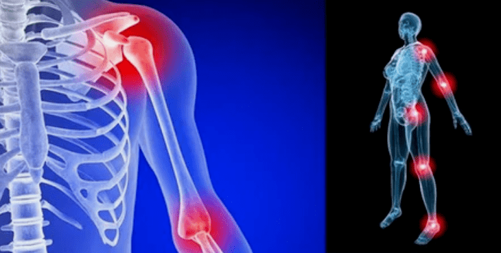 The deformation of limbs for arthrosis
