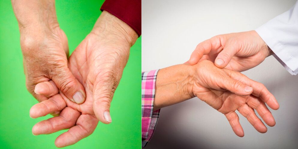 Swelling and aching pain are the first signs of hand arthritis