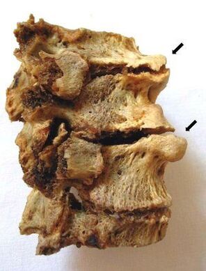 Spinal cord affected by osteochondrosis
