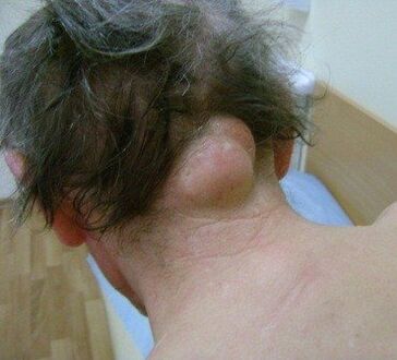 neoplasm as the cause of neck pain