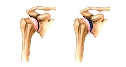 healthy and osteoarthritis shoulder joint