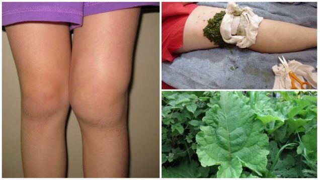An herbal compress for osteoarthritis of the knee