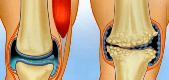 Normal combination and arthrosis